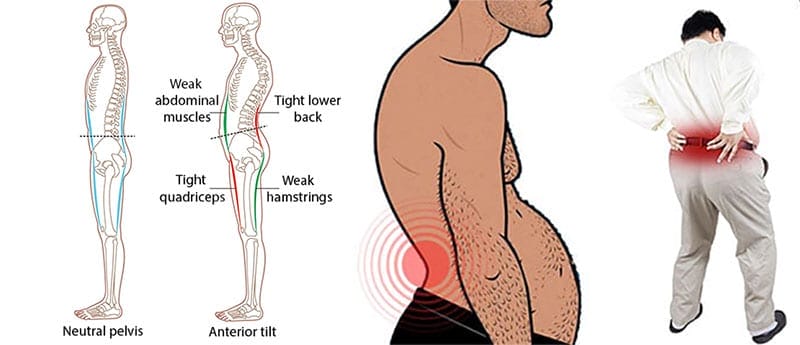 Anterior pelvic tilt