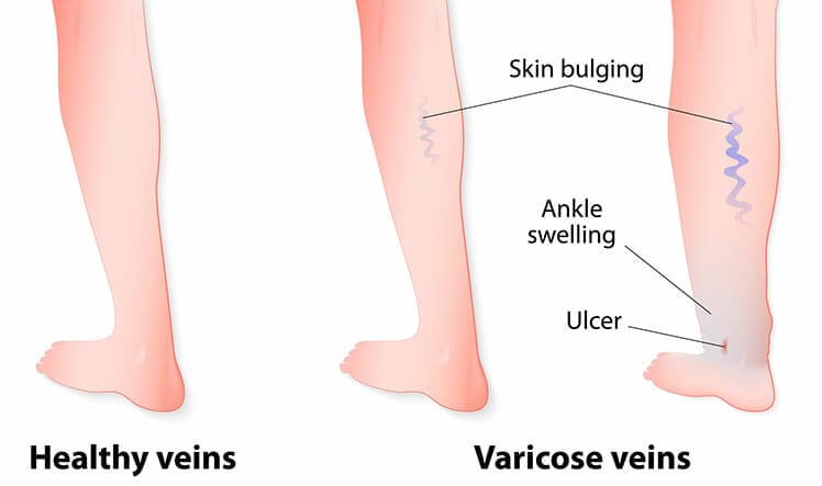 Varicose veins in the legs