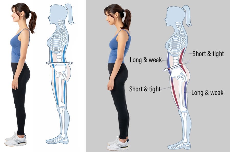 Side-view comparison of a woman with neutral standing posture and anterior pelvic tilt, overlaid with skeletal diagrams showing muscle length-tension differences and pelvic rotation during relaxed standing.