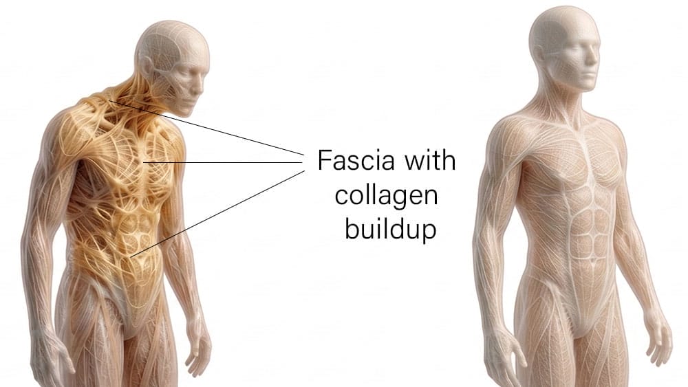 Two anatomical figures showing the fascial system. Left figure in poor posture with thickened, knotted amber-coloured fascia visible in the neck, shoulders and upper back, labelled as fascia with collagen buildup. Right figure standing upright with fine, evenly distributed fascial fibres throughout the body.
