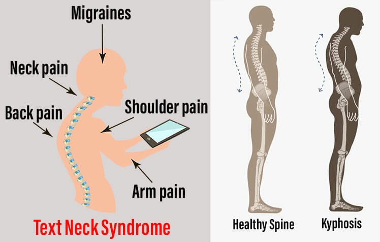 Text neck syndrome effects