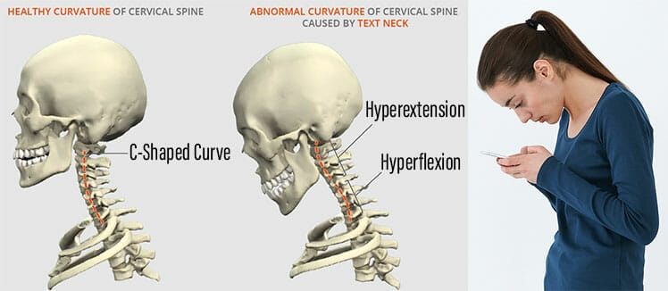 Text neck problem