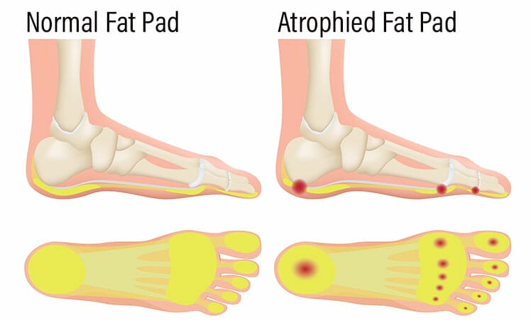 Fat Pad Atrophy Syndrome