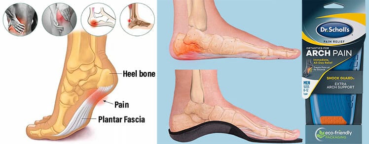 Plantar Fasciitis explained