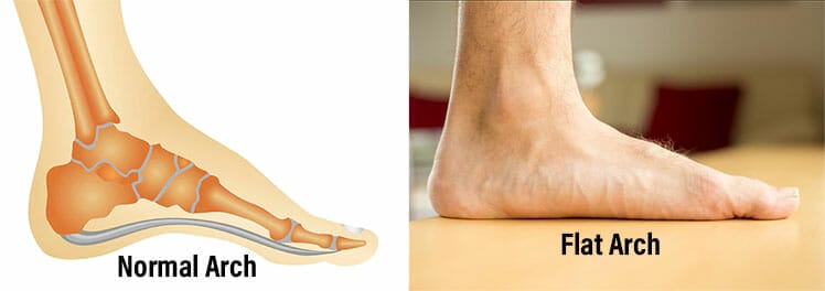 Examples of healthy and flattened foot arches
