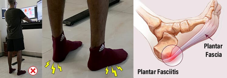 Plantar fasciitis from excessive standing