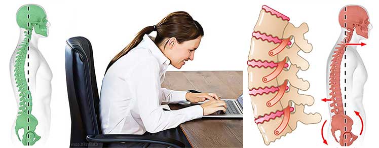 Illustration showing how slouched postures strain the five lower back discs